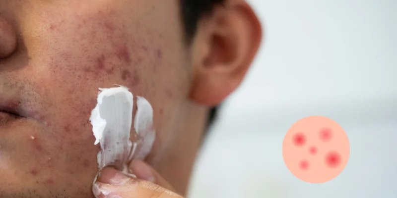 How to Deal with Breakouts Prone Skin?